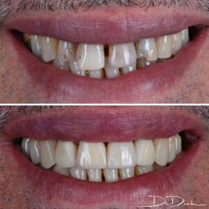 Crowns and composite bonding